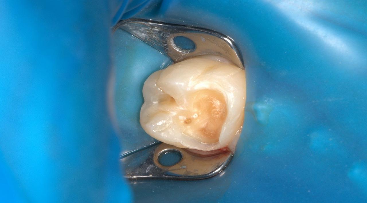 Лікування під мікроскопом