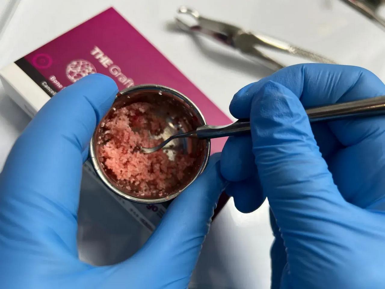 Синус-ліфтинг