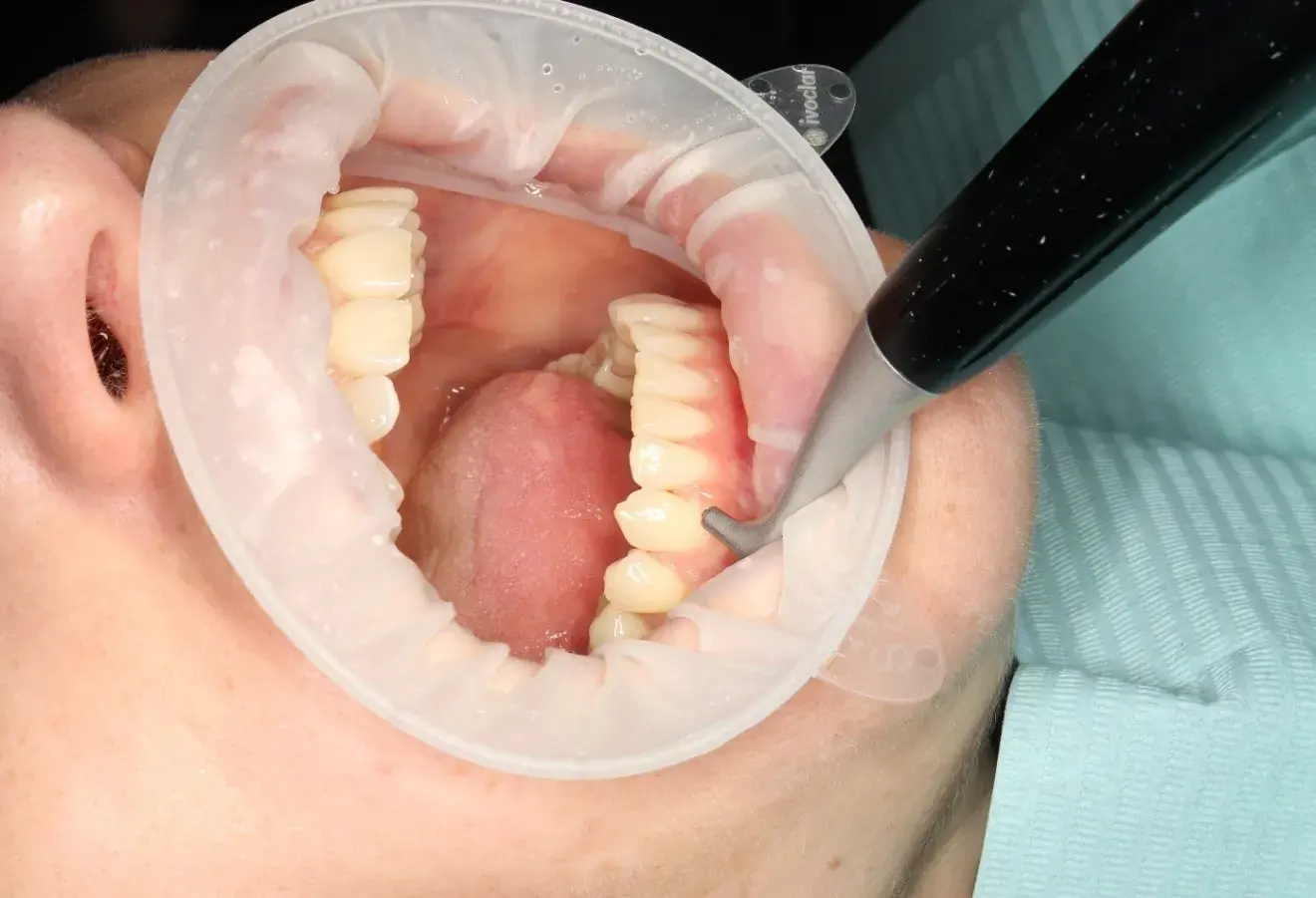 Професійна чистка зубів Air Flow