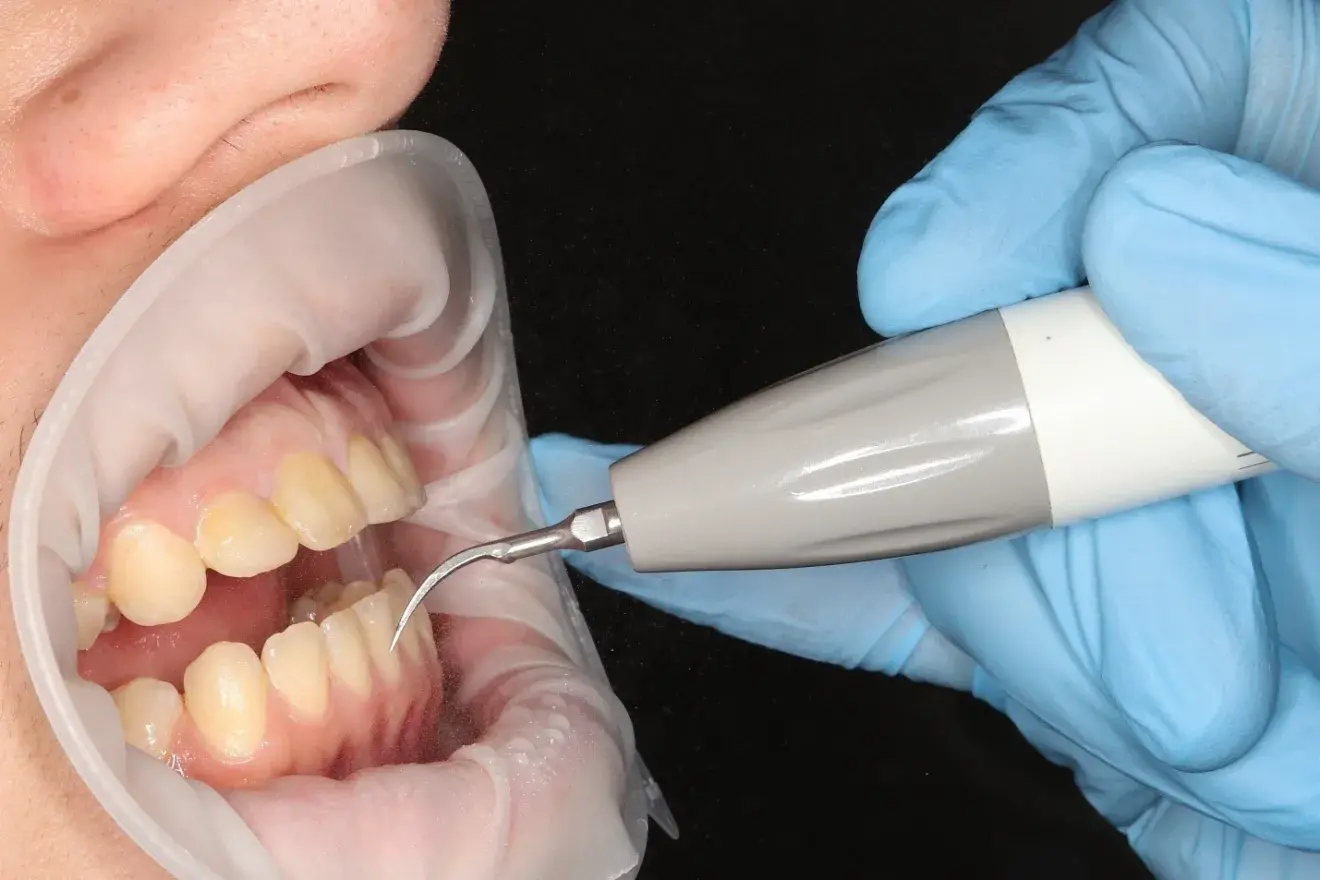 Ультрозвукова чистка